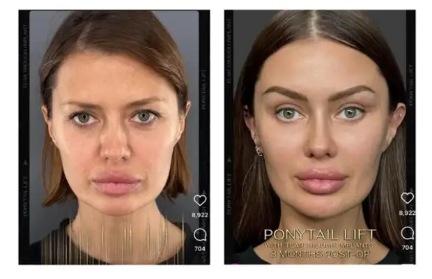 Омоложение лица до и после. Морщины на лице. Короткорубцовый смас лифтинг. Эндоскопический лифтинг лица. Миндально фитиновый пилинг.