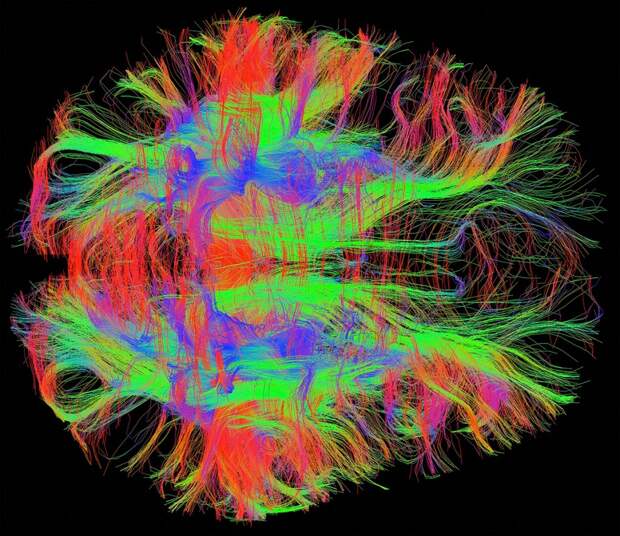 Нервные волокна мозга здорового взрослого человека, МРТ