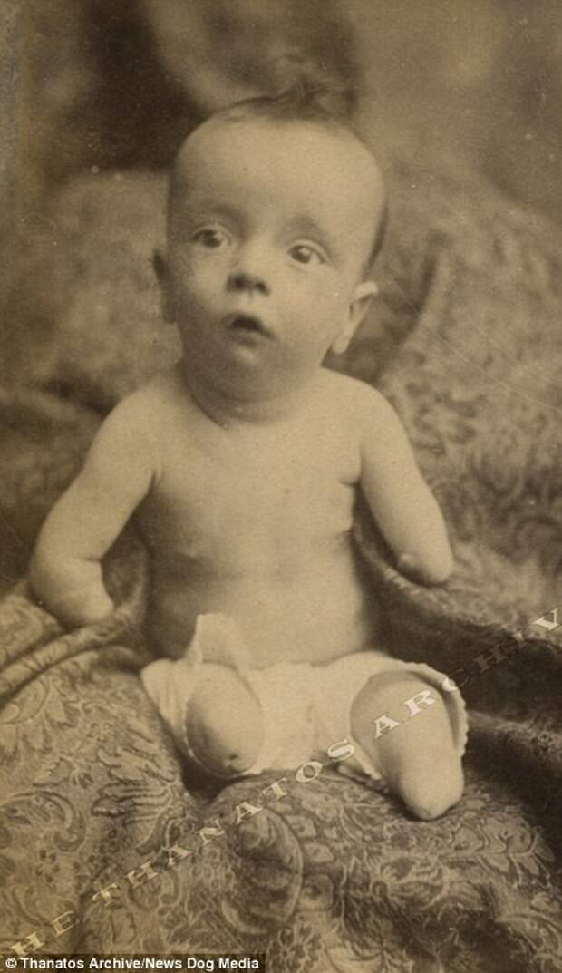 Чарльз Льюис родился без ног и рук в 1885 году деформация, люди