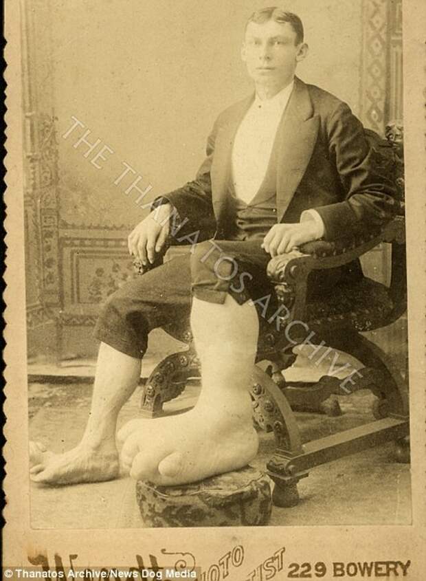 Мужчина с элефантиазом, 1890-е годы деформация, люди