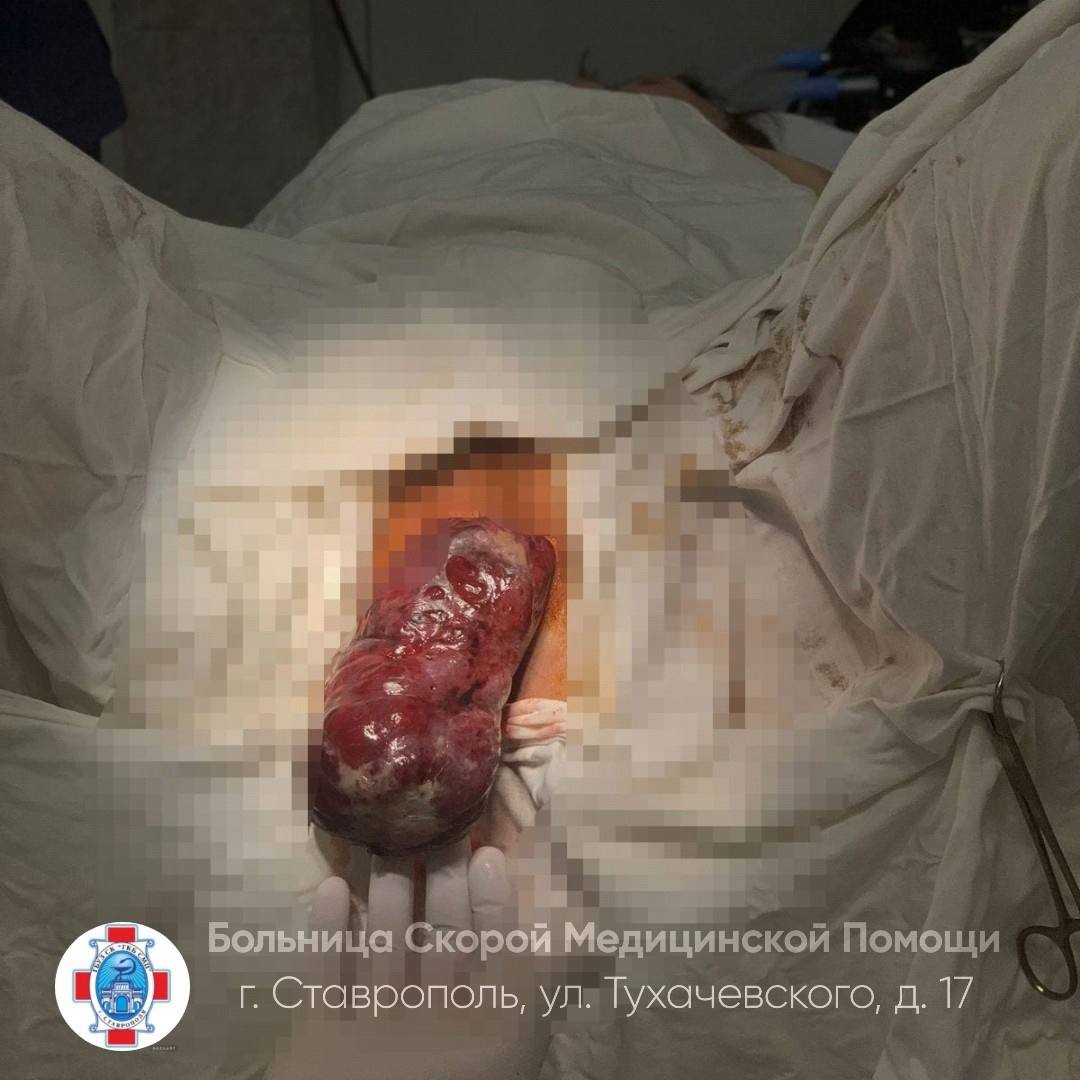 В ГБУЗ СК «ГКБ СМП» Ставрополя обратилась пациентка с жалобами на ощущение инородного тела в области промежности и кровянистые выделения из половых путей. При осмотре был выявлен рождающийся субмукозный узел больших размеров. После проведения обследования, пациентку прооперировали. Миоматозный узел был удален, затем произведено ушивание ножки узла. Матку удалось сохранить.