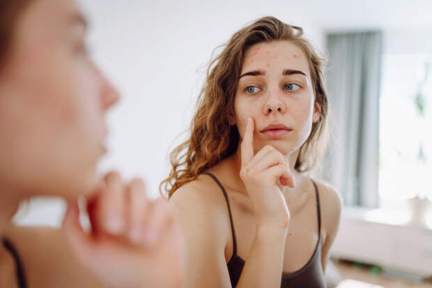 Годами страдающая от акне россиянка выявила неожиданную причину недуга