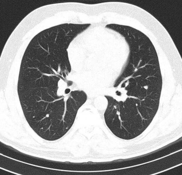 Насколько эффективна КТ грудной клетки при пневмонии