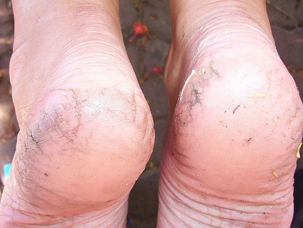 cracked-heels-610x460
