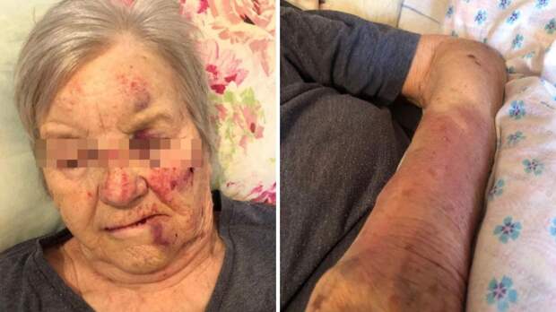 Пожилую пациентку жестоко избили в пансионате Новосибирска