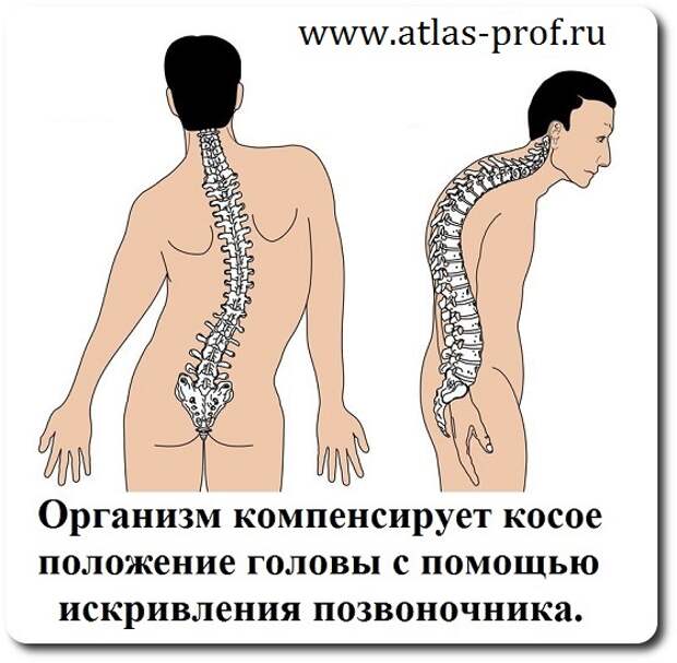 искривление позвоночника