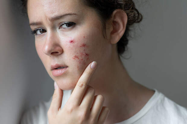 Дерматолог Котова: стресс провоцирует себорейный дерматит, экзему и розацеа