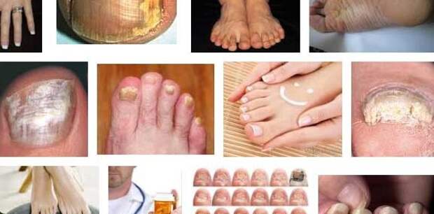 Грибок ногтей на ногах — причины, симптомы, профилактика, лечение, что важно знать