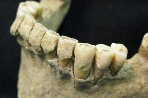 Зуб - единственная часть человека, лишенная способности самовосстанавливаться
