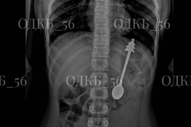 Врачи в Оренбургской области достали 14-сантиметровую ложку из желудка ребенка