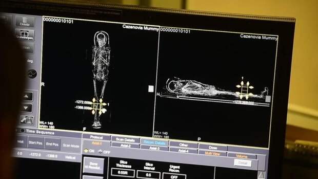 Врачи диагностировали у мумии рак — через 2 тысячи лет после смерти в мире, видео, интересно, мумия, наука, открытие, рак, ученные