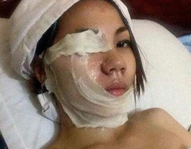 Девушка из Камбоджи попыталась облить кислотой своего бывшего жениха. Из-за ветра кислота попала на лицо ей самой