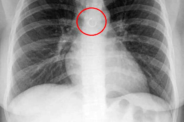 Fox News: мексиканка случайно проглотила кольцо из носа, которое попало в легкие