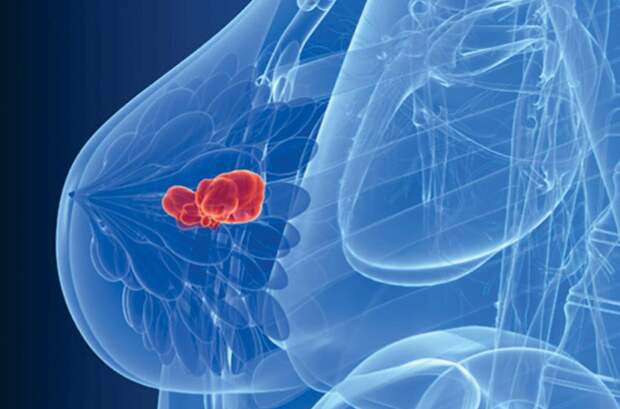 Какие типы уплотнений в груди указывают на рак?