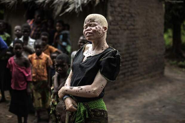 Части тела альбиносов используются в магических ритуалах.