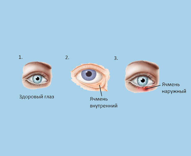 Ячмень на глазу: 8 актуальных и безопасных способов борьбы Ячмень на глазу: 8 актуальных и безопасных способов борьбы