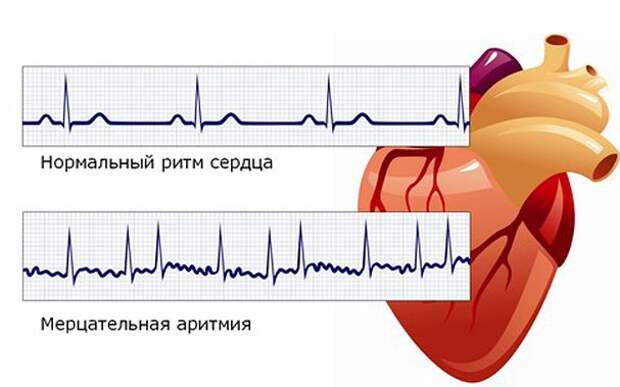 Как быстро замедлить учащенное сердцебиение, вызванное тревогой и сердечной аритмией