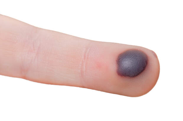 bloodblister-shutterstock-161739158-webonly