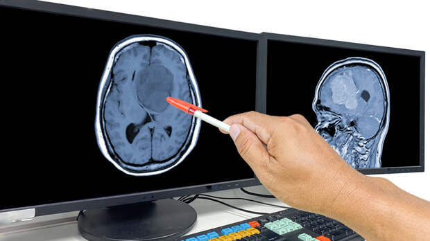 Онколог Черёмушкин рассказал о симптомах глиобластомы