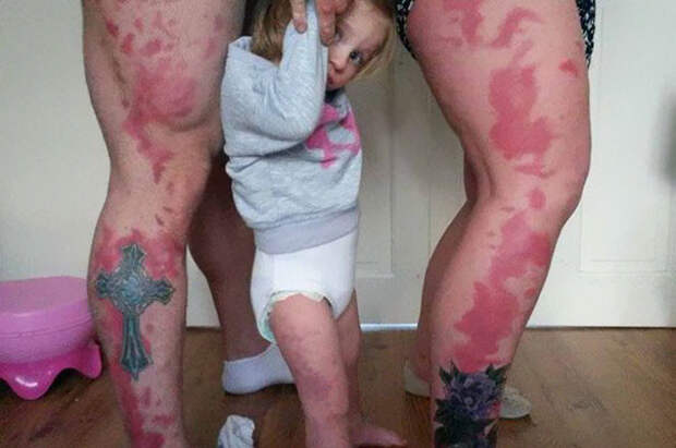 7. Родители сделали татуировку в форме родимого пятна своей дочери, чтобы она не чувствовала себя 