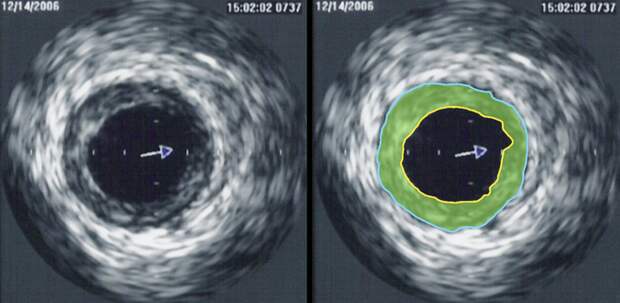 Ультразвуковая диагностика выявила сужение венечной артерии. Зона бляшки отмечена зелёным цветом. Фото: wikipedia