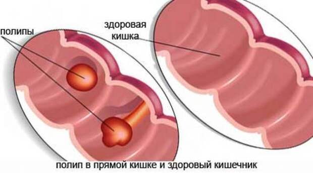 Что такое полипы в кишечнике? Симптомы, диагностика, методы лечения, реабилитационный период после удаления
