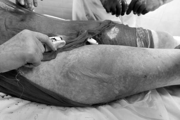 В Перми девушки потребовалась пересадка кожи из-за угрожающего жизни синдрома