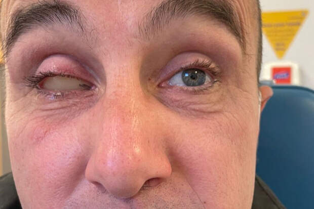 Британец получил порез во время купания в бассейне отеля и лишился глаза