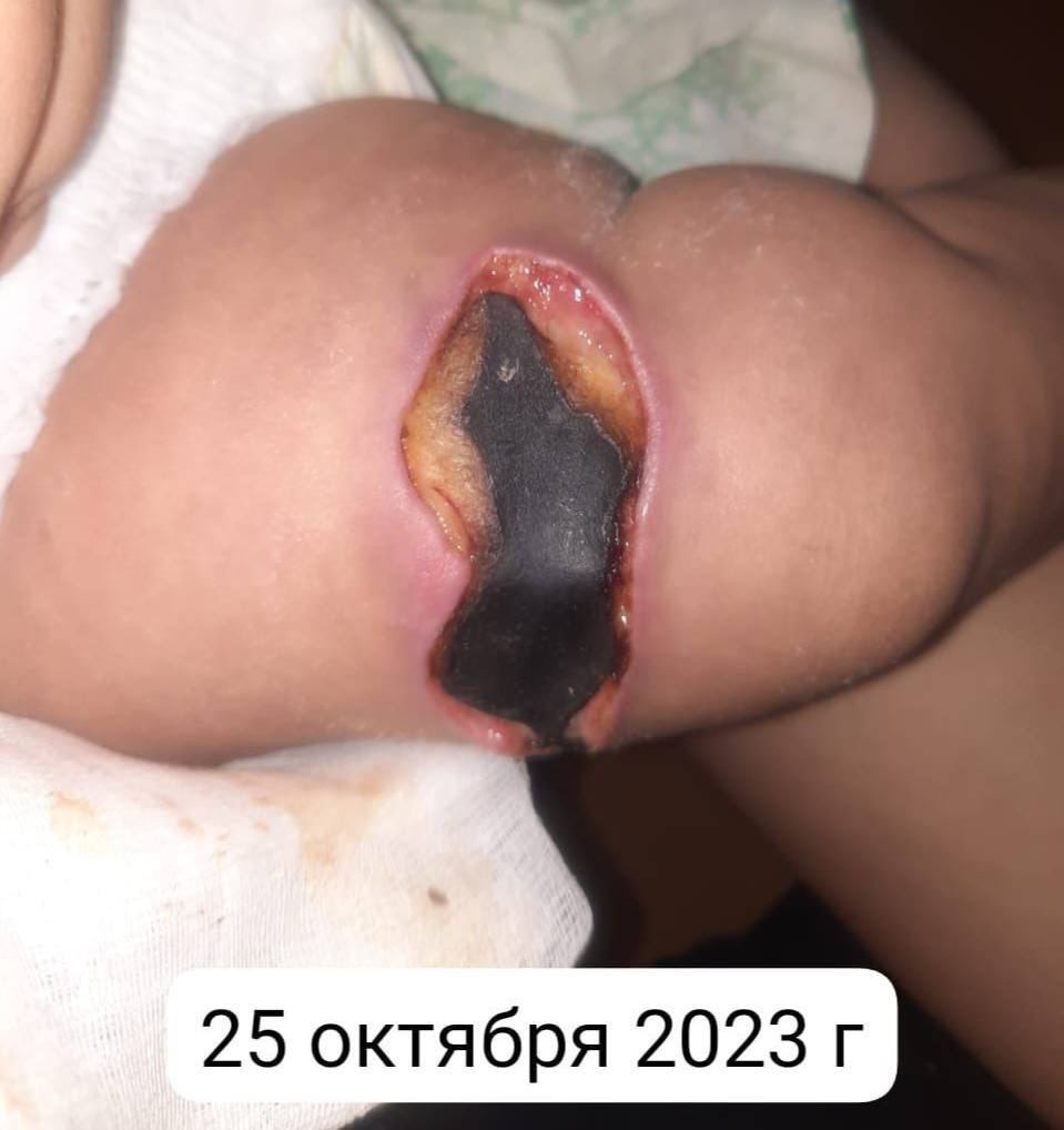 Жительница Якутска рассказала в социальных сетях о развитии некроза кожи правого бедра у ее восьмимесячного ребенка после вакцинации препаратом «Пентаксим».  Сообщается, что после прививки у ребенка поднялась температура до 39,2 ℃ и появилось покраснение в месте укола. Пришедший на вызов педиатр якобы порекомендовал делать йодную сетку. Через 3 дня кожа на ноге ребенка почернела, появилась, по словам матери, «опухоль с гноем». Дата постановки вакцины не уточняется. 