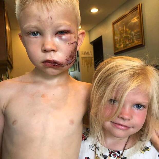 Мальчик вступился за 4-летнюю сестренку, на которую напала агрессивная собака – и получил 90 швов