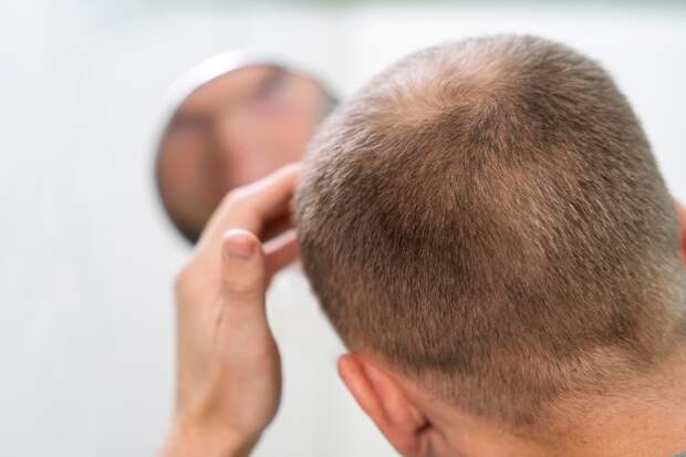 Новое средство против выпадения волос, вызванного алопецией