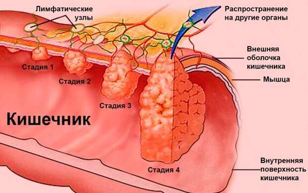 Клеточные изменения и рак Все виды рака начинаются в клетках. Наше тело состоит из более чем ста миллионов миллионов (100 000 000 000 000) клеток.