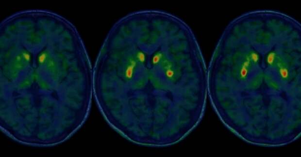 Япония первой в мире одобрила препарат на основе аллогенных ИПСК для болезни Паркинсона