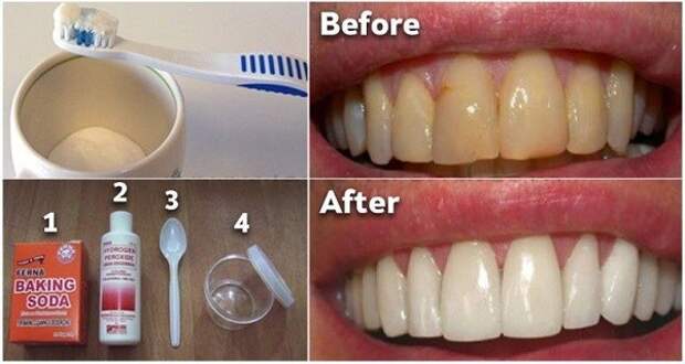 How-To-Get-Rid-Of-Plaque-and-Whiten-Your-Teeth-Without-Expensive-Treatments-770x402