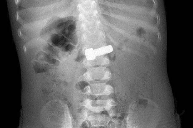 В Подмосковье врачи спасли ребенка с болтом в желудке