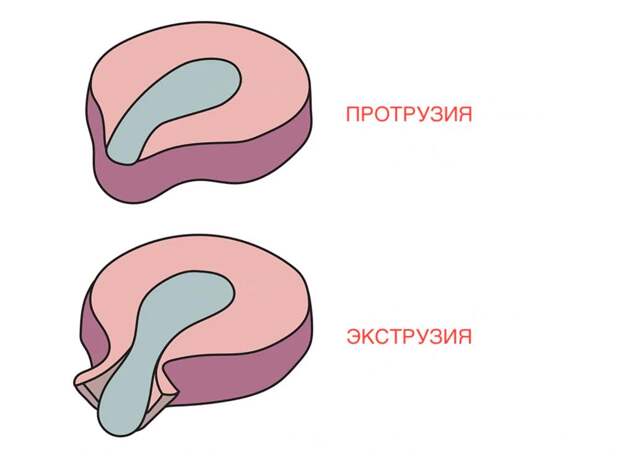 Протрузия диска - лечение в Тюмени