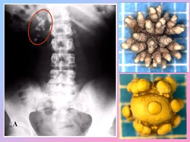 Щавелевая кислота и оксалаты в продуктах питания и в вашем теле