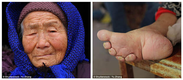 Эта 95-летняя старушка - представительница последнего поколения китайских женщин, уродовавших ступни ног подобным образом модификации, модификация тела, народы мира, традиции мира