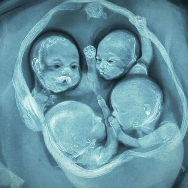 В Петербурге впервые в России родились однояйцевые четверняшки