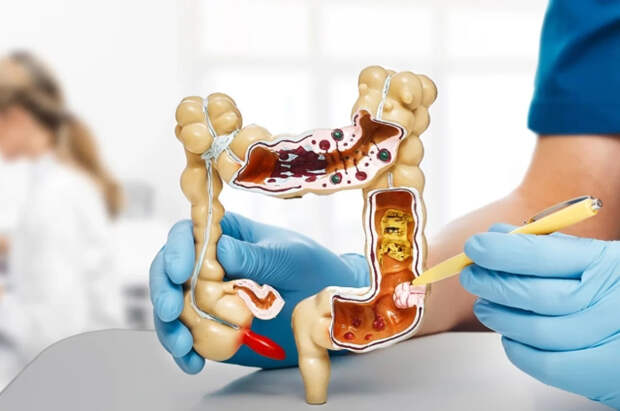 Врач Диллон дал 10 советов для снижения риска развития рака кишечника
