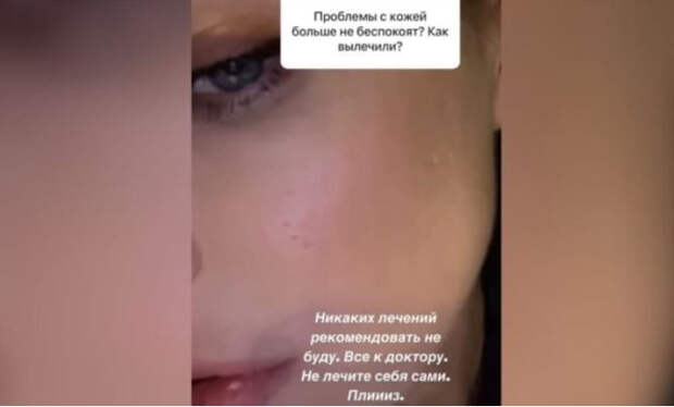 Темникова показала рубцы на лице после тяжелой формы акне