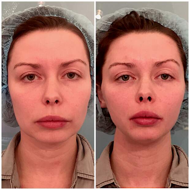 Нитевая подтяжка лица: фото до и после процедуры