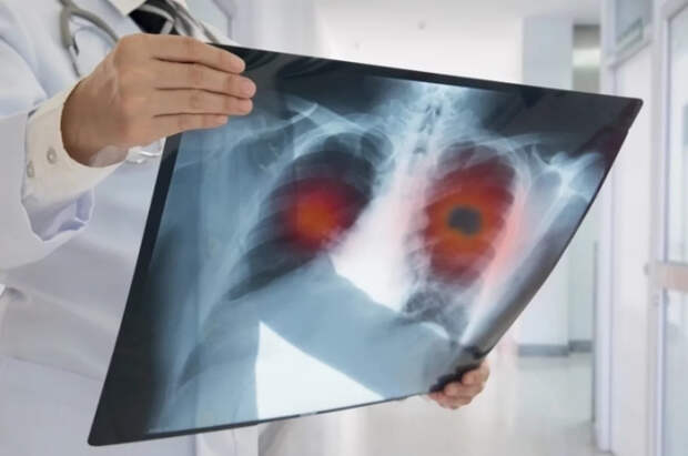 Daily Mail: боль в плече у британца оказалась симптомом рака