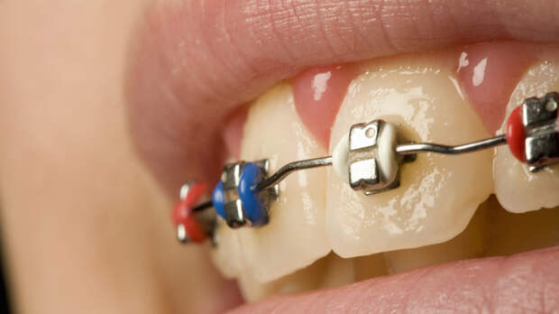 Стоматолог Антипенко назвал противопоказания для установки брекетов