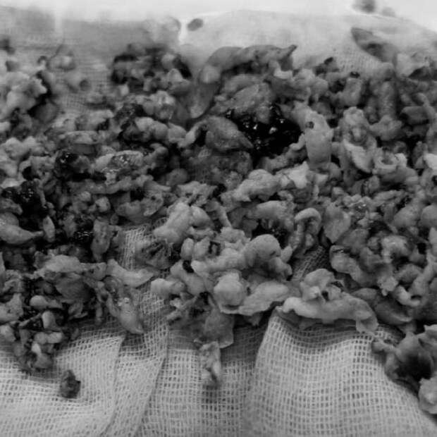 В ГАУЗ «Городская больница № 5» Набережных Челнов поступил мужчина с массивным мочепузырным кровотечением и острой задержкой мочи. При обследовании, включавшем цистоскопию, УЗИ и КТ, был выявлен источник кровотечения — варикозное расширение вен шейки мочевого пузыря. Также у пациента диагностировали аденому простаты больших размеров и гематому мочевого пузыря. Состояние требовало срочного хирургического вмешательства.