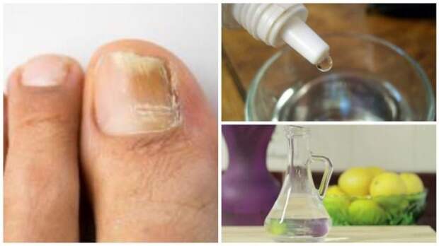 Fabrica-tu-propio-rompe-hongos-natural-para-las-u--as-696x391