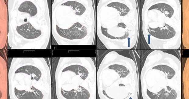 Синдром коротких теломер выявился в симптомах слабости у молодой пациентки