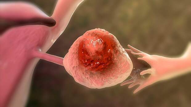 Вот как распространяется рак яичников до того, как врачи смогут его обнаружить