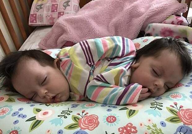 Сиамские близнецы не оправдали прогнозы врачей - живут уже второй год вместо отведенных им суток 