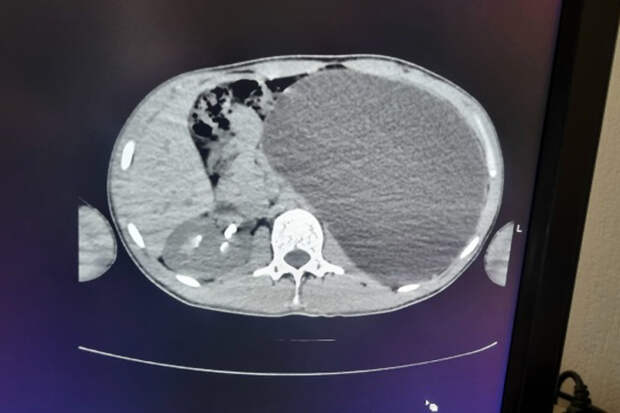 Почку с пятилитровую бутыль обнаружили на УЗИ у юноши в Новосибирске